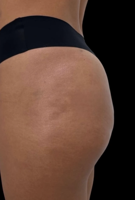 Antes do procedimento