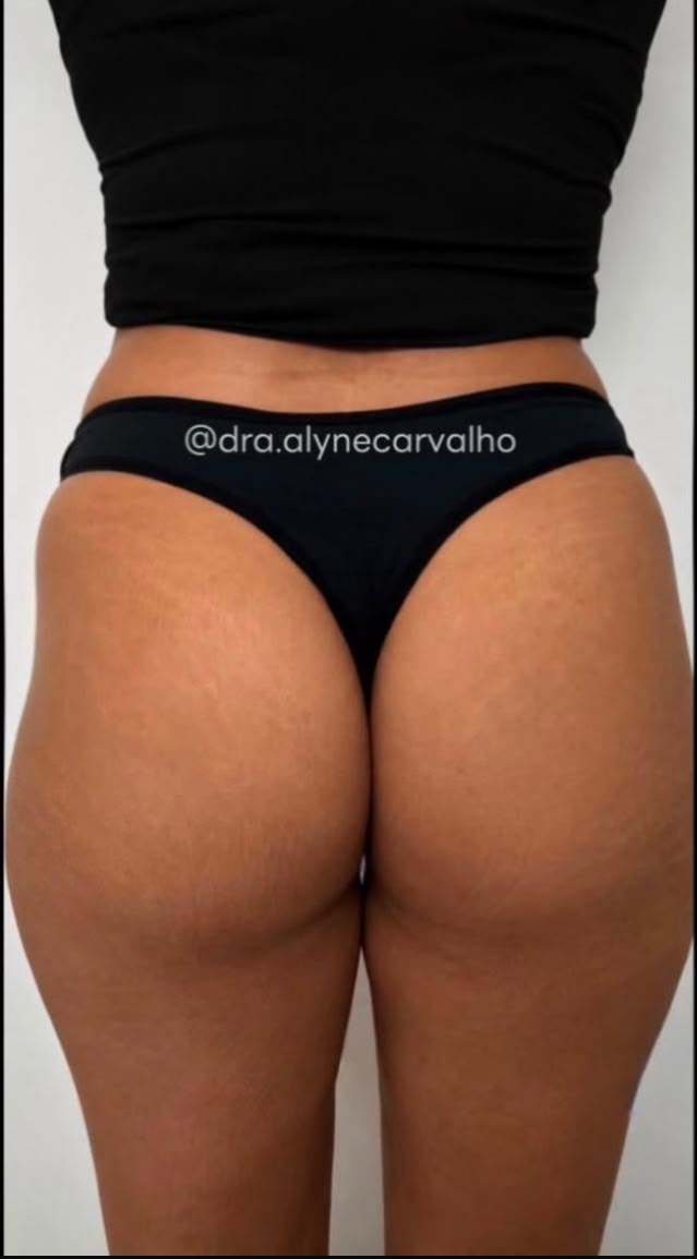 Antes do procedimento